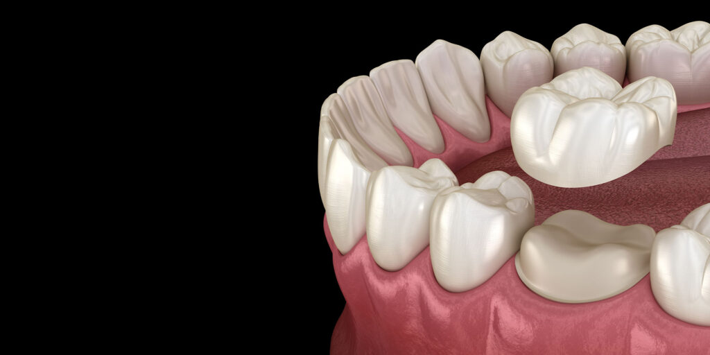 dental crown 3d