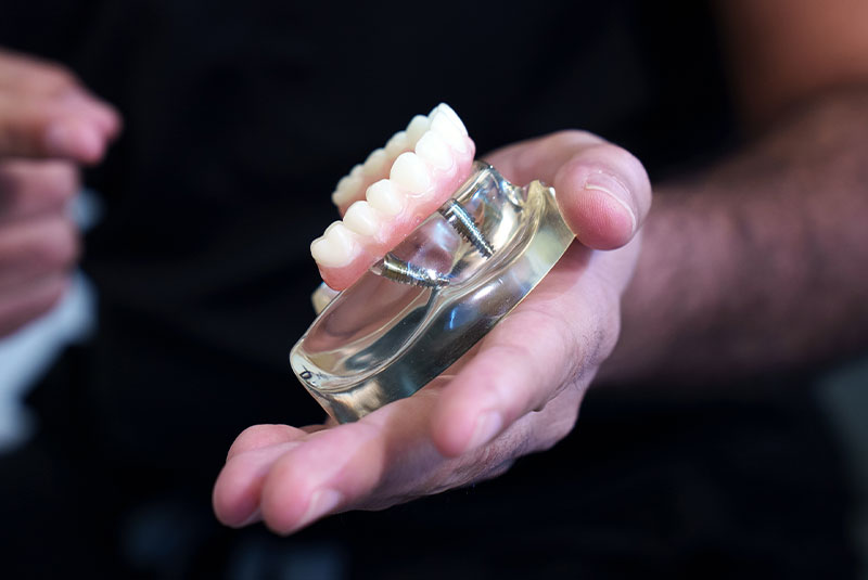 full arch dental implant in hand