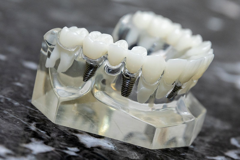 implant bridge