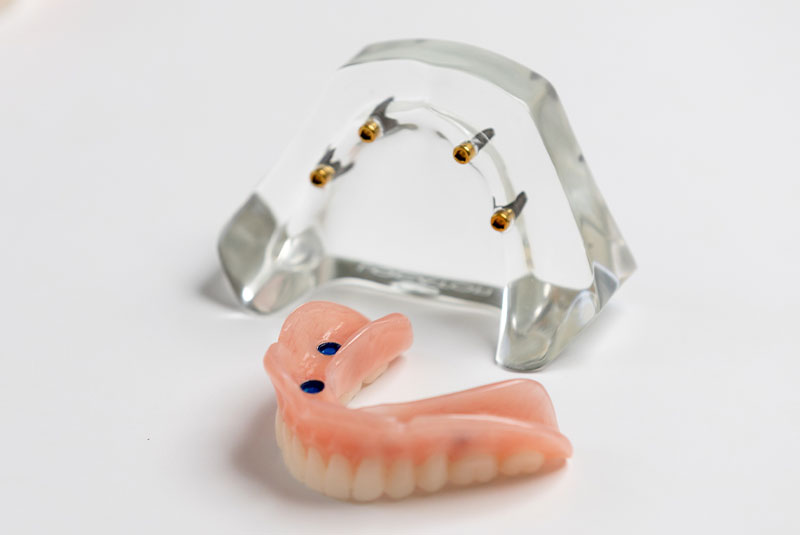 implant denture