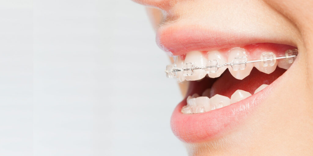 braces close up