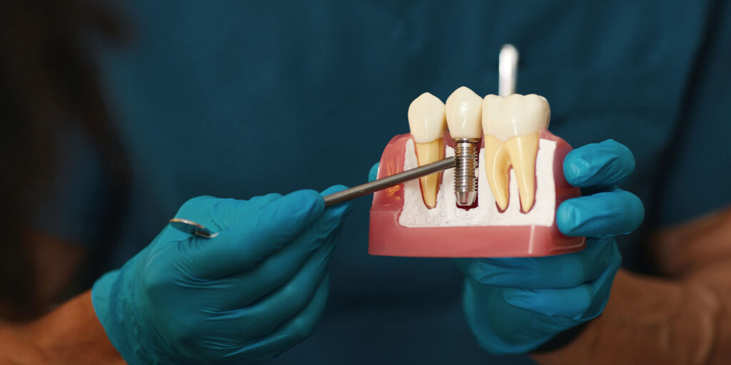 doc pointing to dental implant
