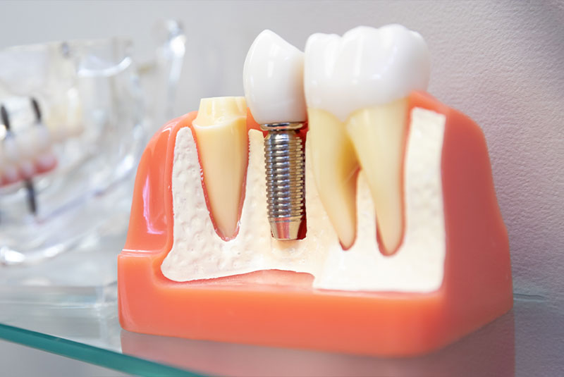 single dental implant model