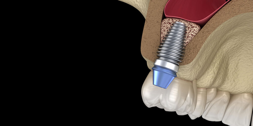 sinus lift 3d