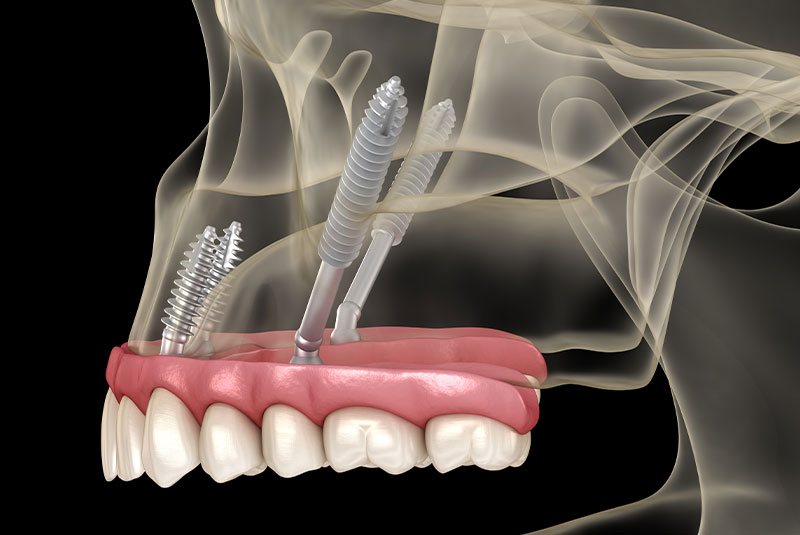 zygomatic dental implant 3d